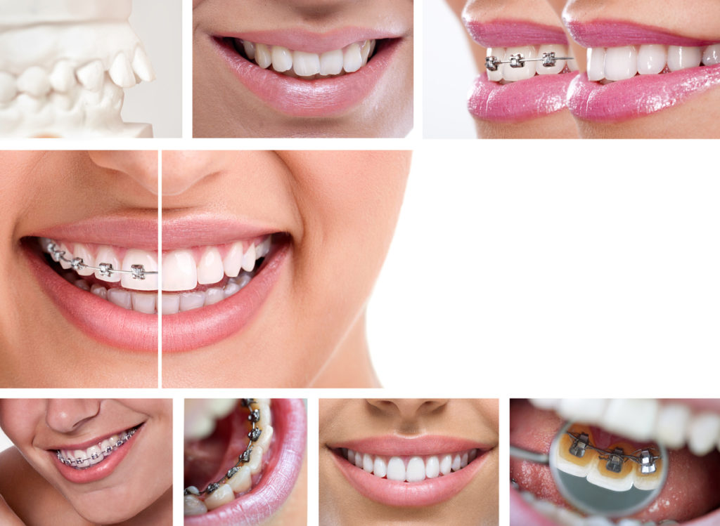 orthodontic braces